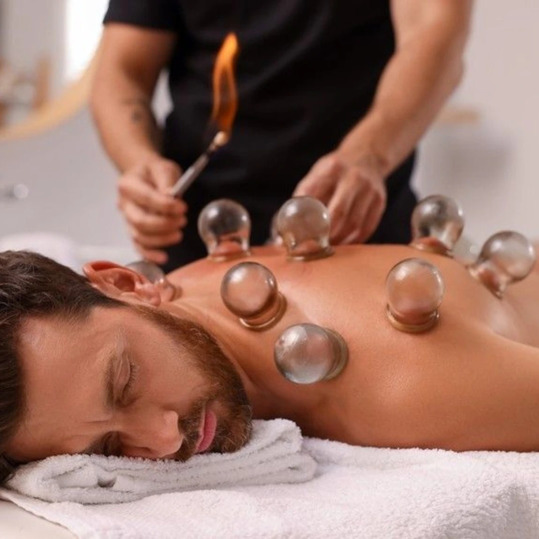 Cupping therapy